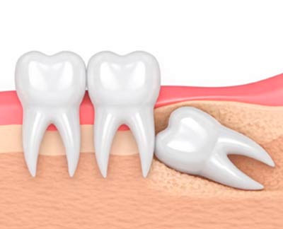 siso-incluso-e-impactado