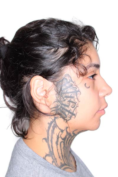 bichectomia2